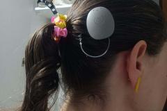 Paraná assume liderança nacional em implantes cocleares pelo SUS